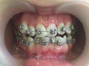 Изображения по запросу Dental Braces